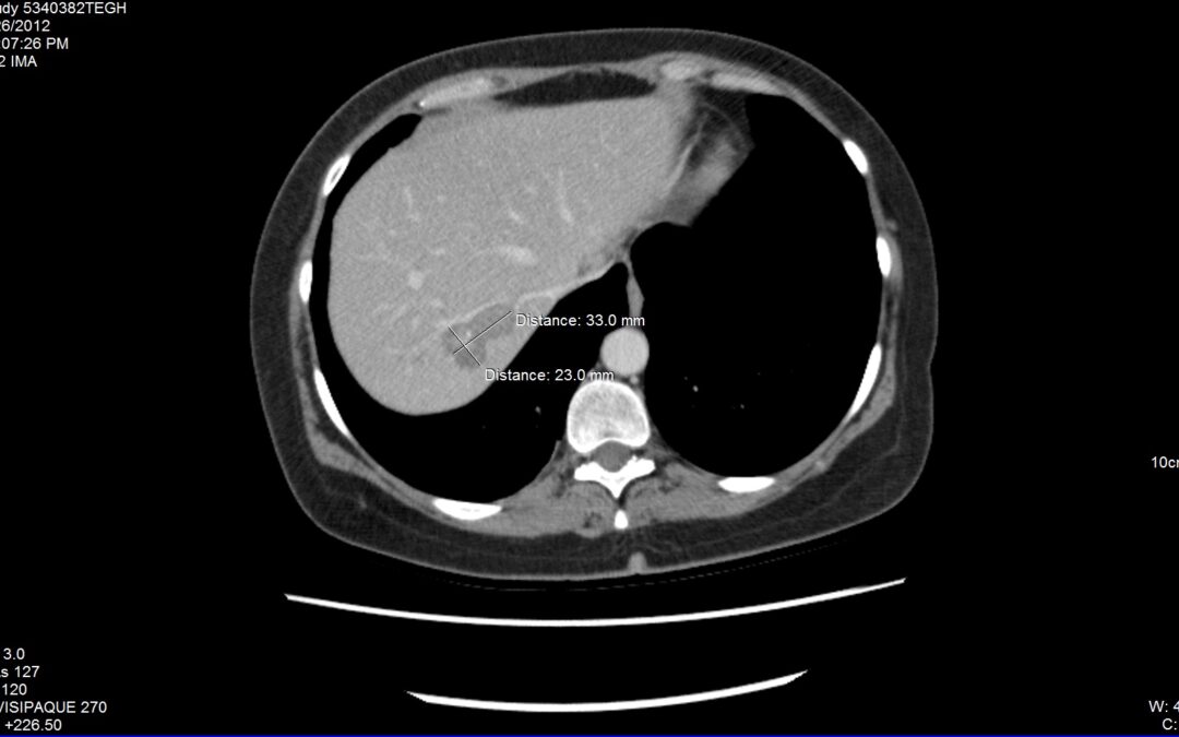 Colon Cancer Long-Term Survival – DCA