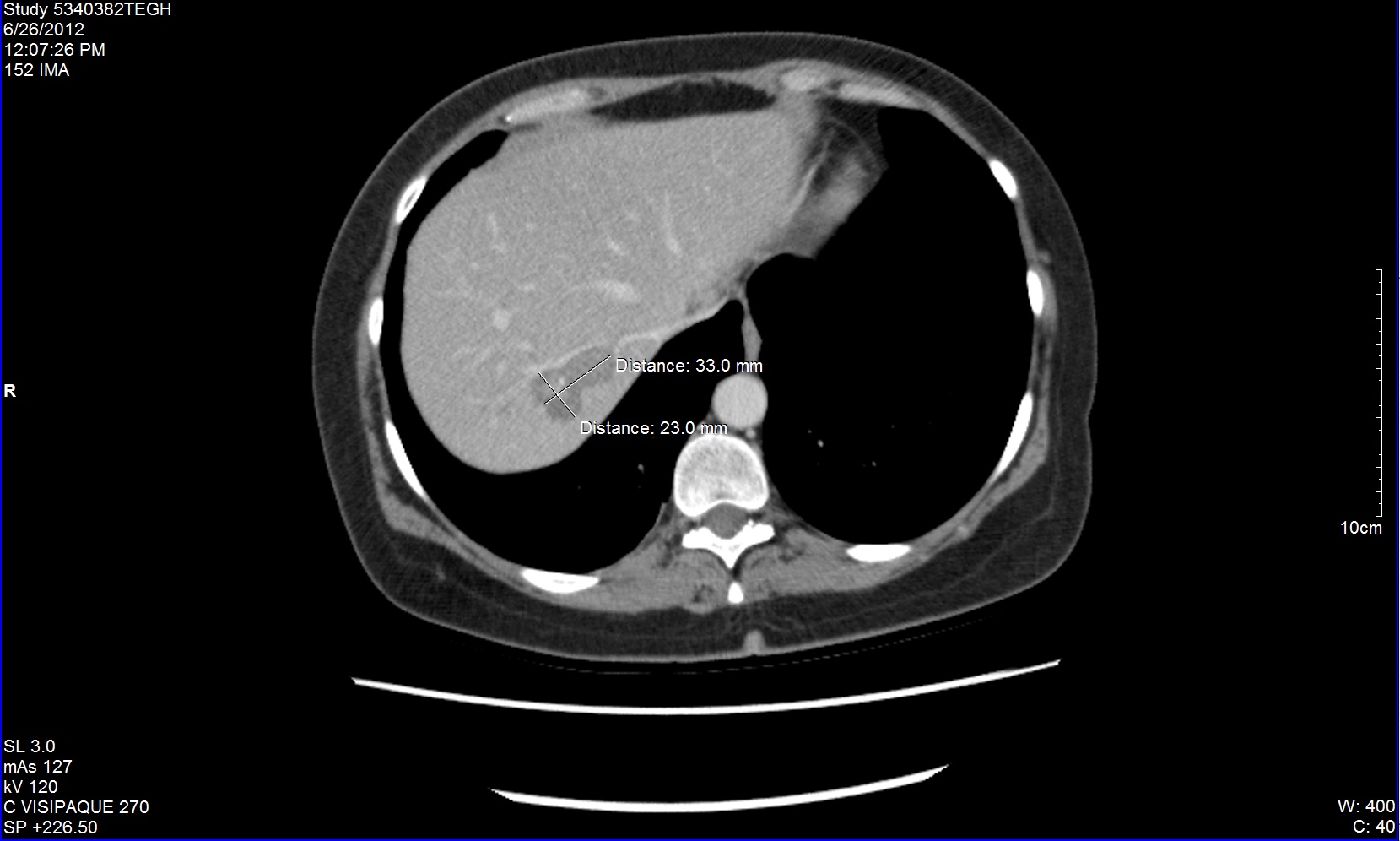 Case 6 CT 2012 Liver 1