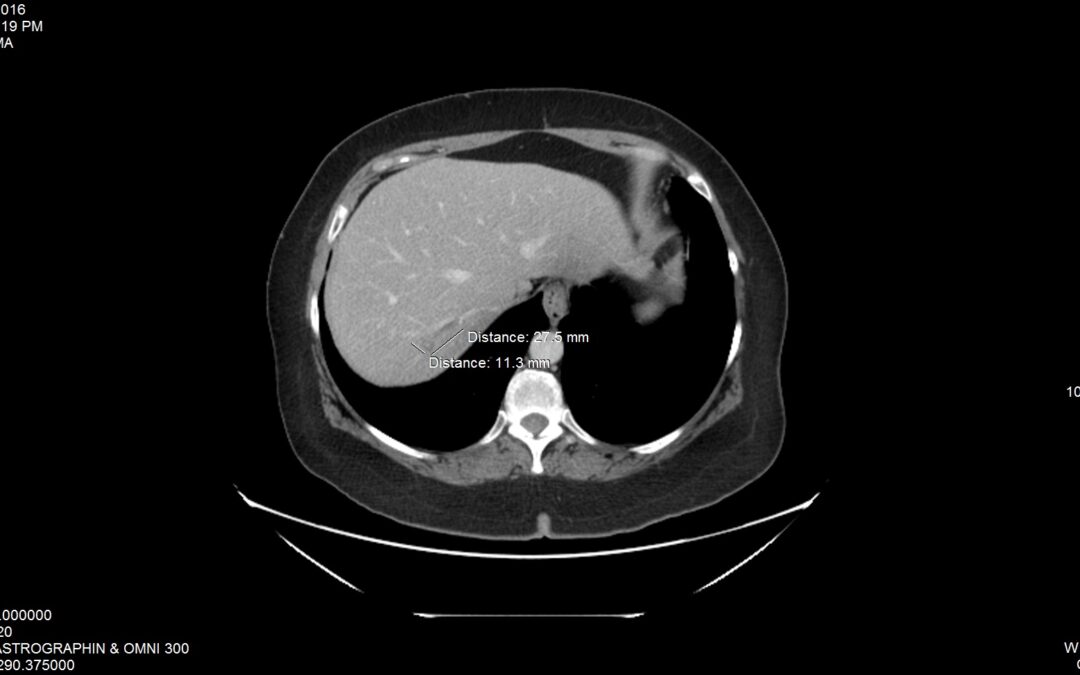 Case 6 CT 2016 Liver 1