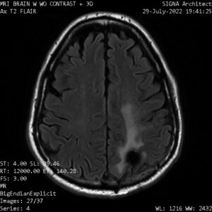 DCA-GBM-Case-9-yrs