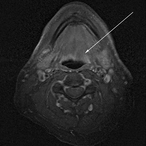LDN Case 1 MRI B