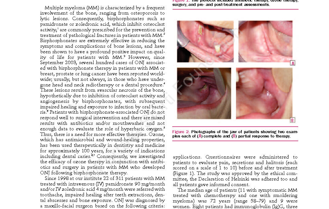 ozone-osteonecrosis-jaw-bisphosphonate